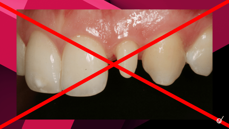 carillas dentales desgaste