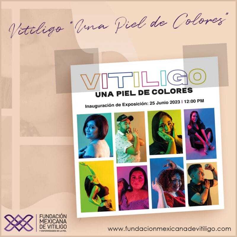 El vitiligo: rompiendo el mito sobre esta enfermedad 5 353784771 278950628027847 501793277344157600 n