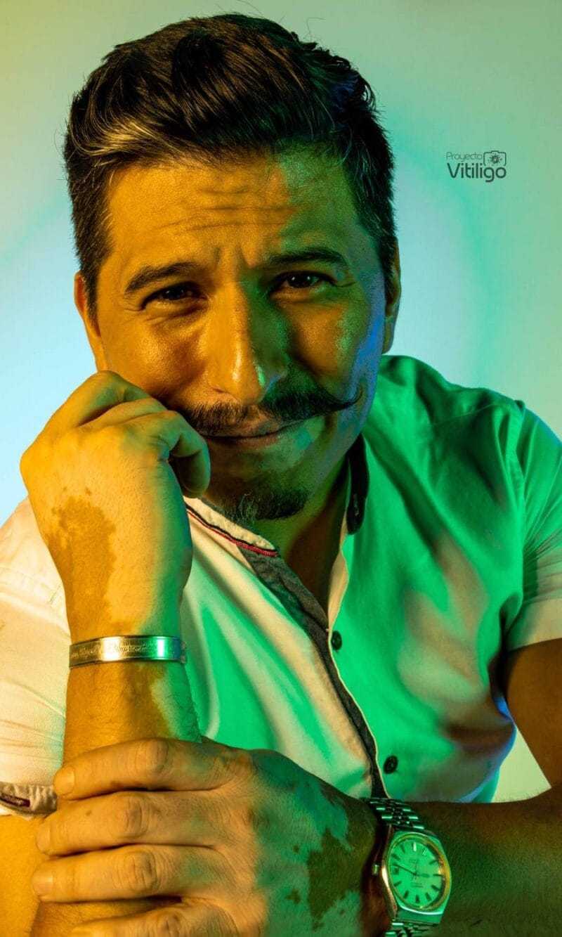 El vitiligo: rompiendo el mito sobre esta enfermedad 2 PROYECTO VITILIGO FOTO 2