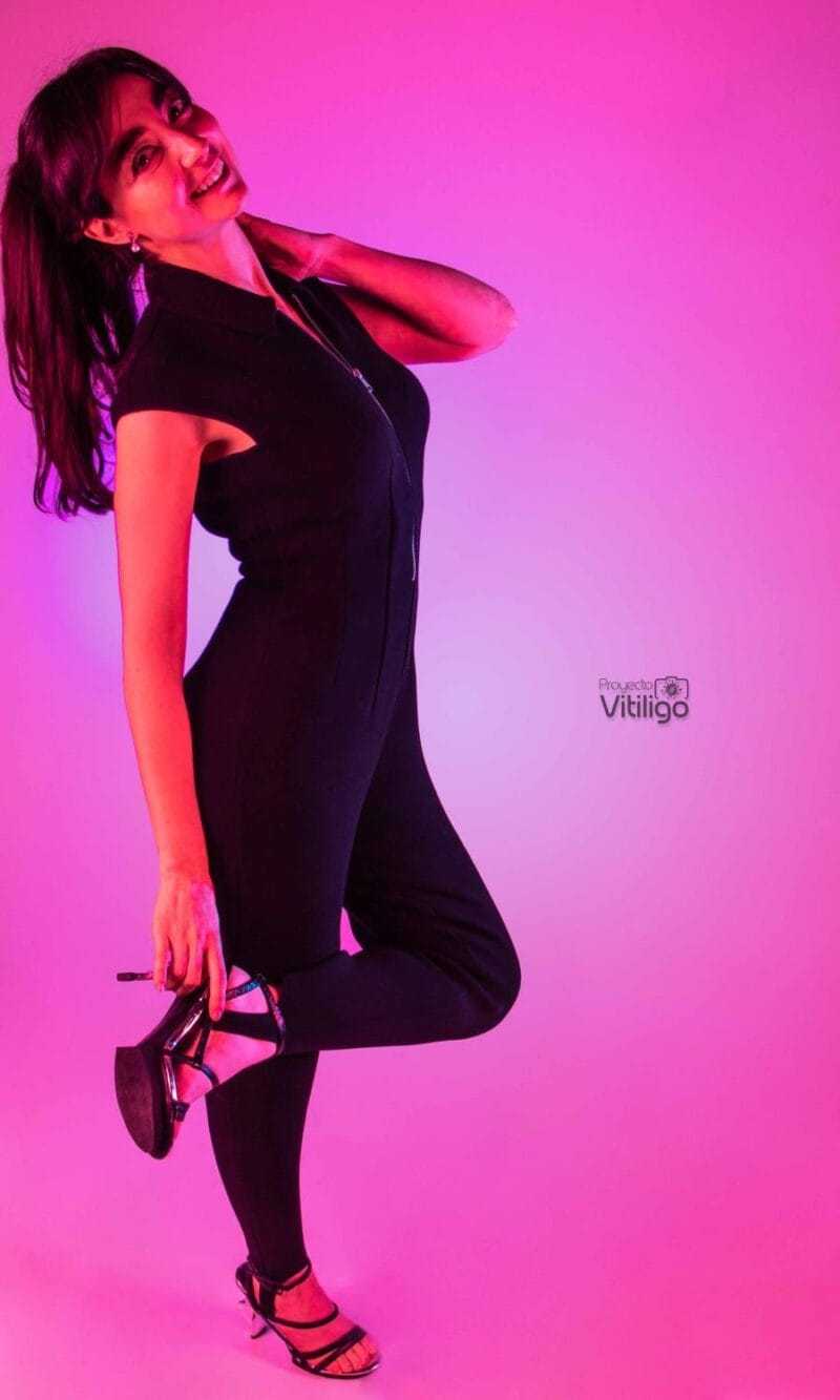 El vitiligo: rompiendo el mito sobre esta enfermedad 3 PROYECTO VITILIGO KAREN