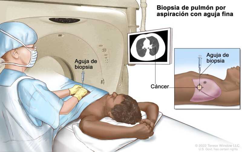 Falso que los tumores sea "bolsitas de toxinas" y que las biopsias los diseminen 1 Proceso de cómo se realiza una biopsiaInstituto Nacional del Cáncer de los Estados Unidos