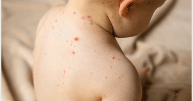 Niño con sarpullido de sarampión en la espalda