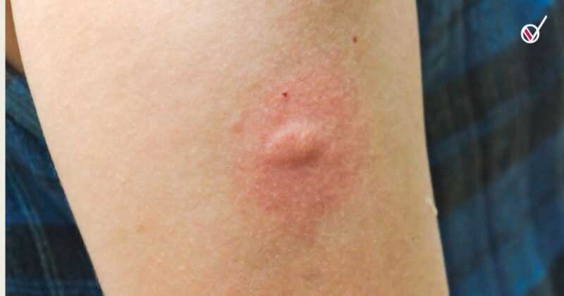 Mosquitos y mitos: por qué algunas personas reciben más picaduras que otras 2 Copia LILA PORTADAS NUEVAS 1